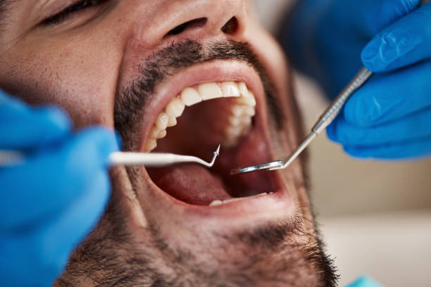 Best Emergency Wisdom Teeth Removal in Greenfield, MO